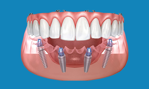 all on 4 dental implants