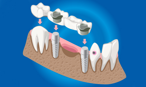 How Long Does a Dental Bridge Last