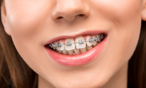 What are the Benefits of Wearing Braces